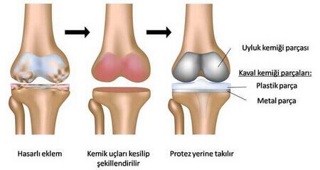 Yüzmenin Eklem Hastalıklarına Faydaları